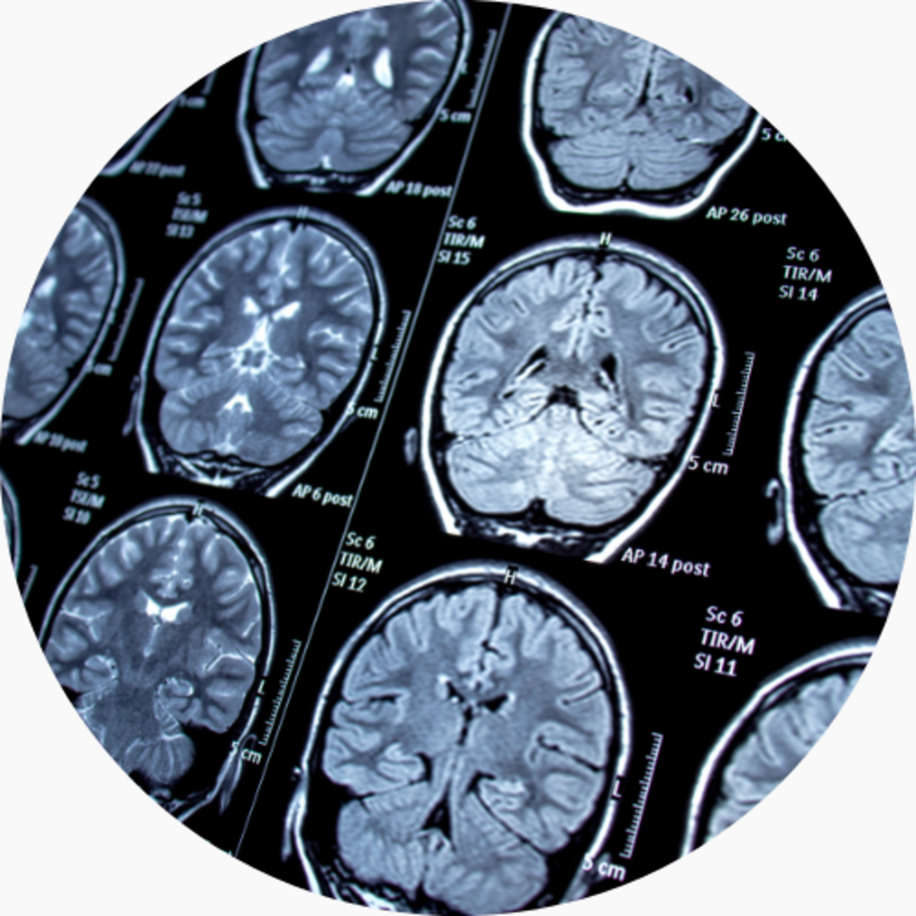 Ketogenic Diet Therapy for Epilepsy and Seizure Control