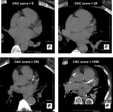 Four original cardiac CT images showing CAC scores of 0, 29, 250, and 1200.