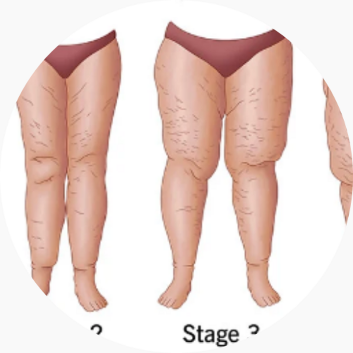 Lipedema Is Not Your Fault: Why Low-Carb Nutrition Belongs in Multimodal Care